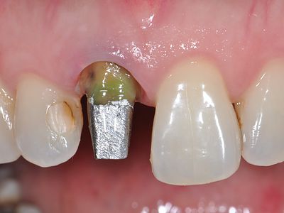 This Upper left lateral inicisor was badly broken down. It was first restored with a CAST POST AND CORE before restoration with a PORCELAIN CROWN.