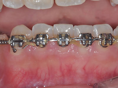 Example of patient undergoing orthodontic treatment