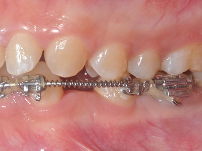 Example of patient undergoing orthodontic treatment