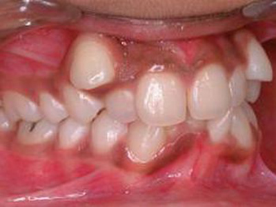 Malocclusion in a 13 year old. She is ready to start orthodontic treatment.