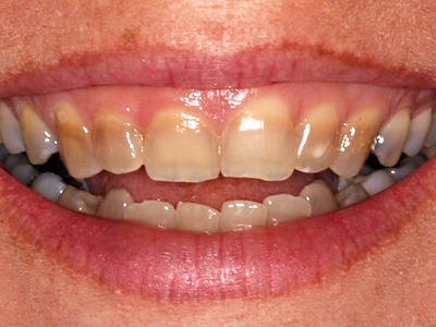 This patient has discoloured teeth because of tetracycline staining