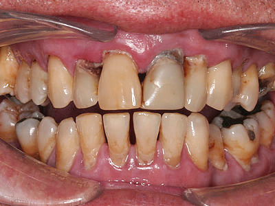 Picture of patient with severe gum disease