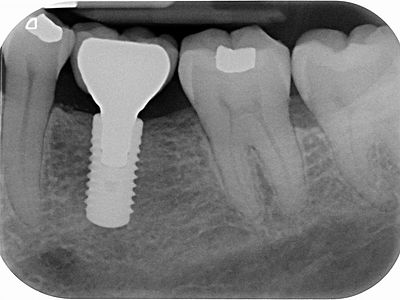 X-ray showinig successful implant of the lower left molar.