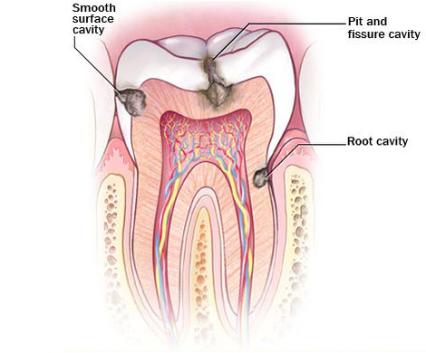 Diagram showing progression of tooth decay